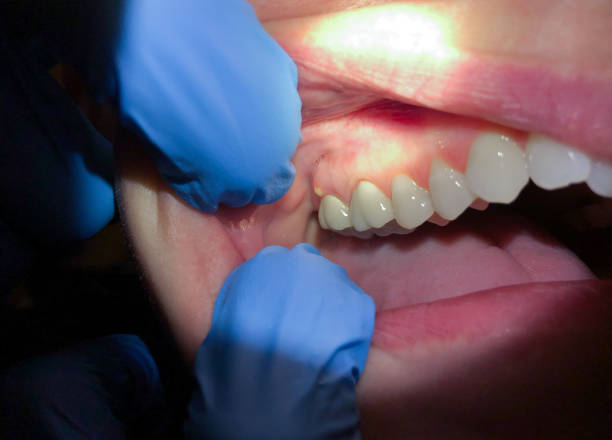 Best Emergency Wisdom Teeth Removal in Moose Wilson Road, WY